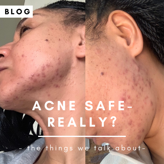 Is it acne-safe makeup?